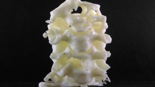 Photo of 3d printed spine of the patient . This was used to measure the gaps between the vertebrae to ensure that the final replacement vertebrae would fit in perfectly.