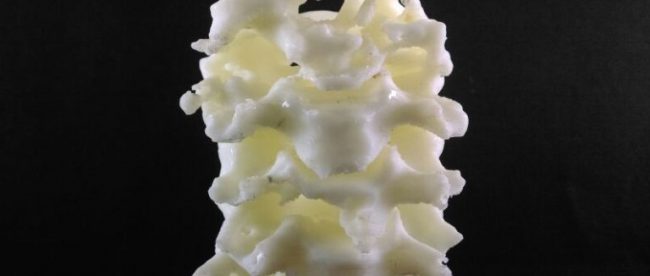 Photo of 3d printed spine of the patient . This was used to measure the gaps between the vertebrae to ensure that the final replacement vertebrae would fit in perfectly.