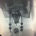 X Ray of 3d printed titanium replica inserted in the spine.