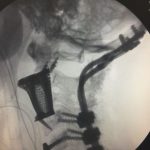 X Ray of 3d printed titanium replica inserted in the spine.