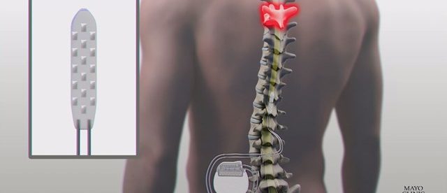 An image showing an electrode inserted in the middle of a person's spine.