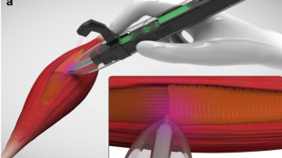 computer generated image shows how the 3d bioprinter can place tissue in the defect site of the muscle. A hand is seen holding the bioprinter right over the muscle that requires regrowth