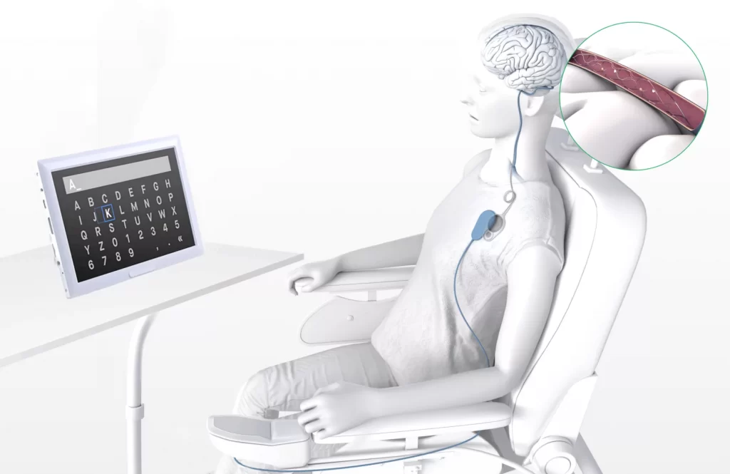 Animated Image of a person using synchron’s brain computer interface.