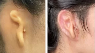 Before and after photo of a patient with microtia - left photo shows underdeveloped ear and right photo shows the transplanted full form ear.