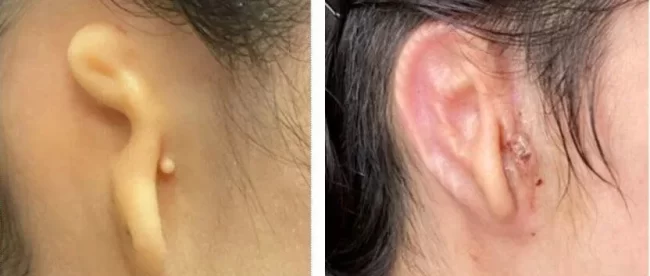 Before and after photo of a patient with microtia - left photo shows underdeveloped ear and right photo shows the transplanted full form ear.