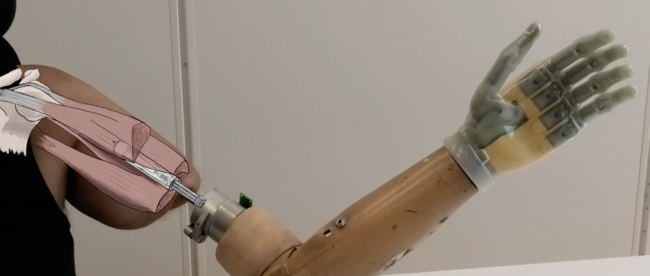 a new bionic hand that allows users with arm amputations to control each finger naturally and effortlessly.